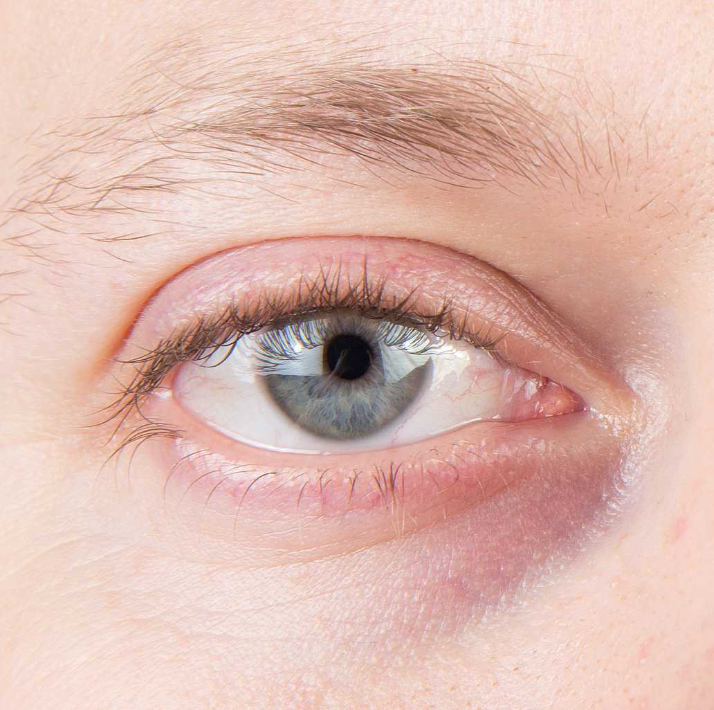 FL - Dunkle Augenringe