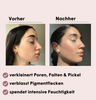 Pore-Refining BB Set