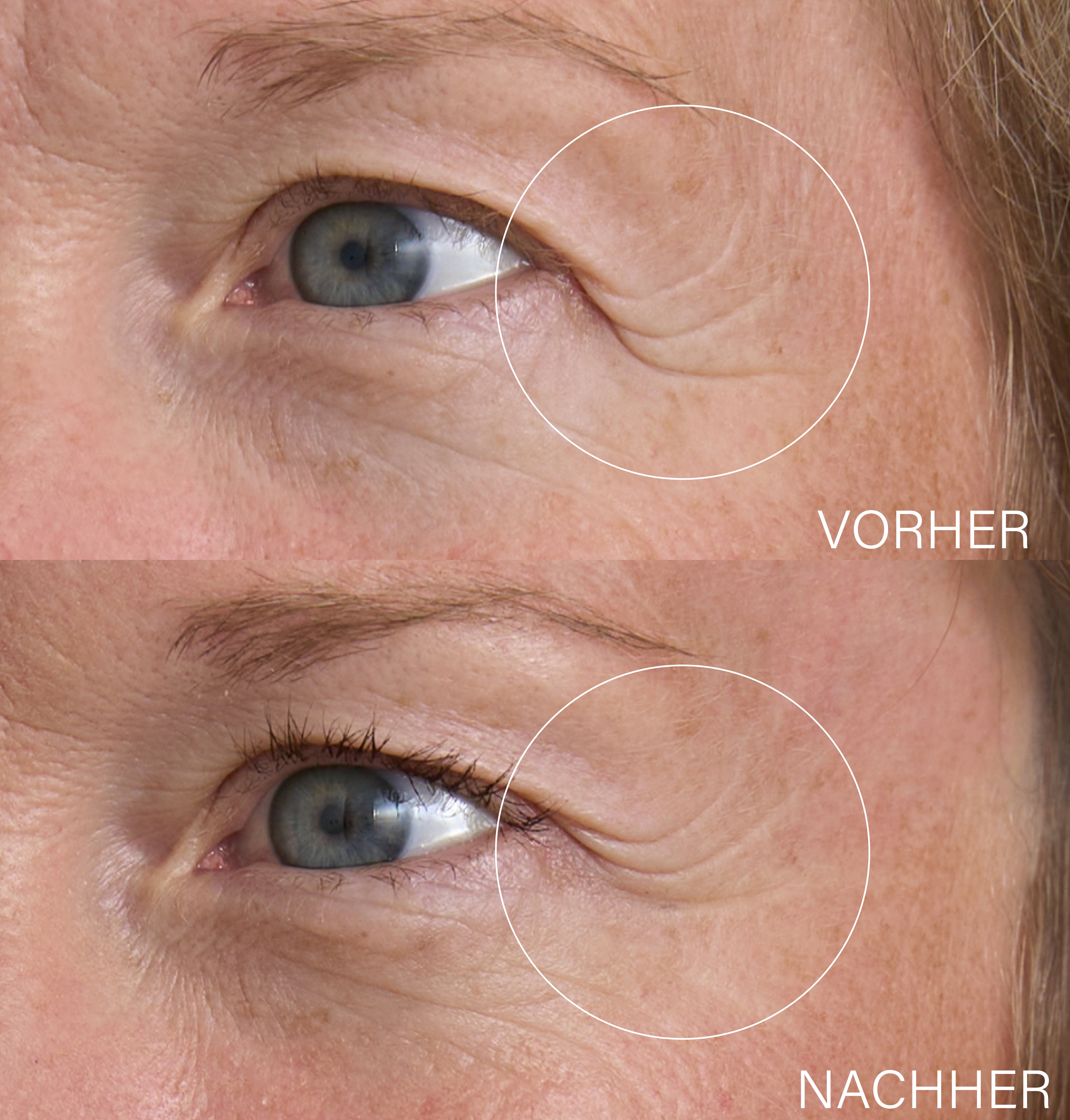 Hyaluron Lifting Duo