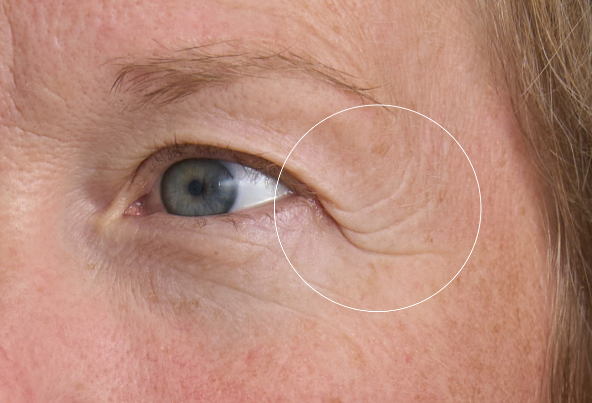 Full Lifting Eye Set