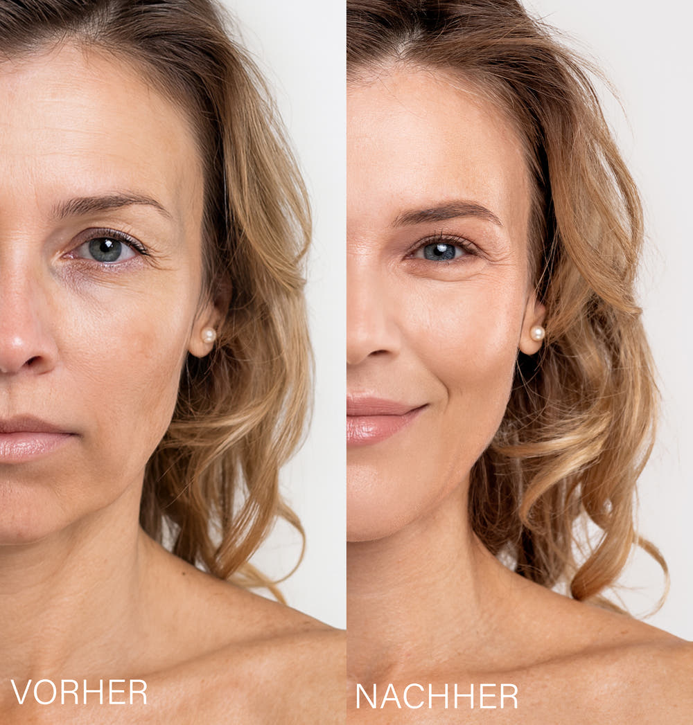 Microneedling Effect Treatment